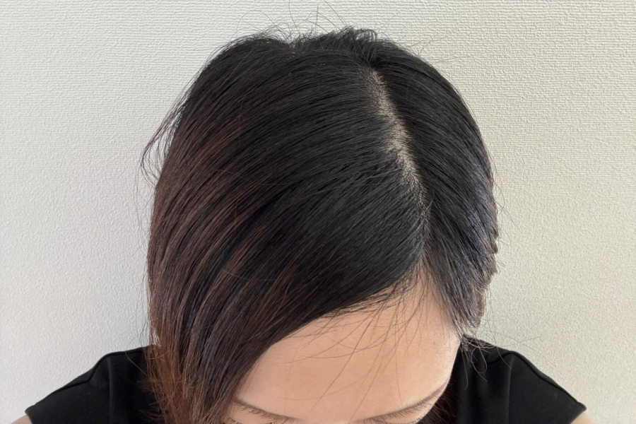 抗がん剤投与開始後2週間たった頭頂部のイメージ画像