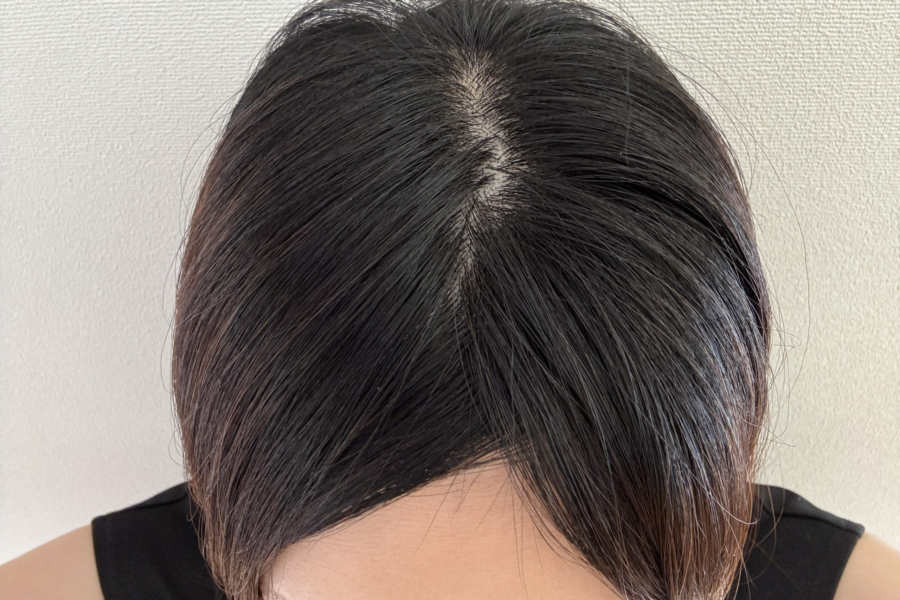 抗がん剤投与開始後１週間たった頭頂部のイメージ画像