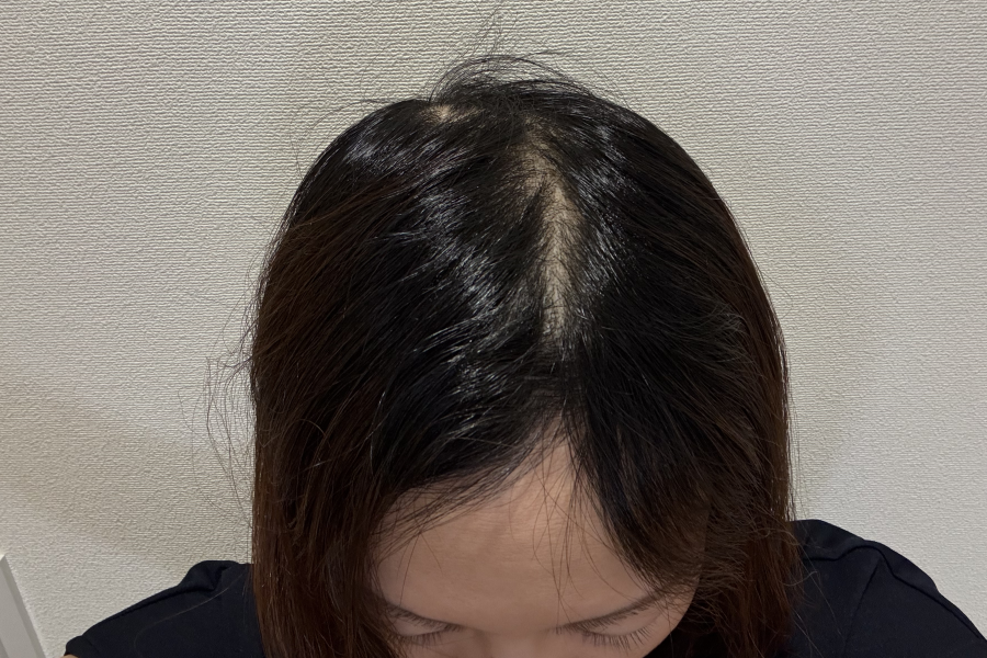 抗がん剤投与開始後６週間たった頭頂部のイメージ画像