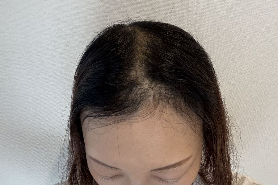 抗がん剤投与開始後１１週間たった頭頂部のイメージ画像