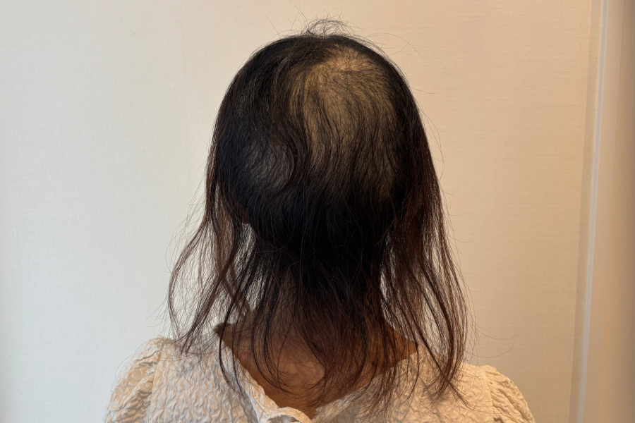 抗がん剤投与開始後13週間たった後頭部のイメージ画像