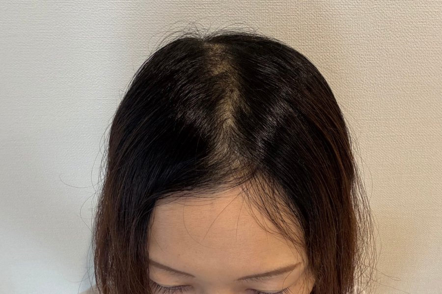 抗がん剤投与開始後８週間たった頭頂部のイメージ画像