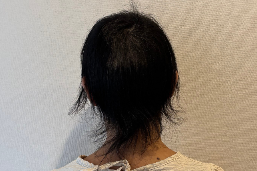 抗がん剤投与開始後２３週間たった後頭部のイメージ画像