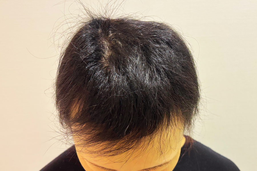 抗がん剤投与開始後24週間たった頭頂部のイメージ画像